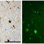 Neruofibrillary tangles (LEFT; darkly stained profiles) and neuritic amyloid-beta plaques (RIGHT; fluorescent green patches) are found years after traumatic brain injury in relatively young individuals.